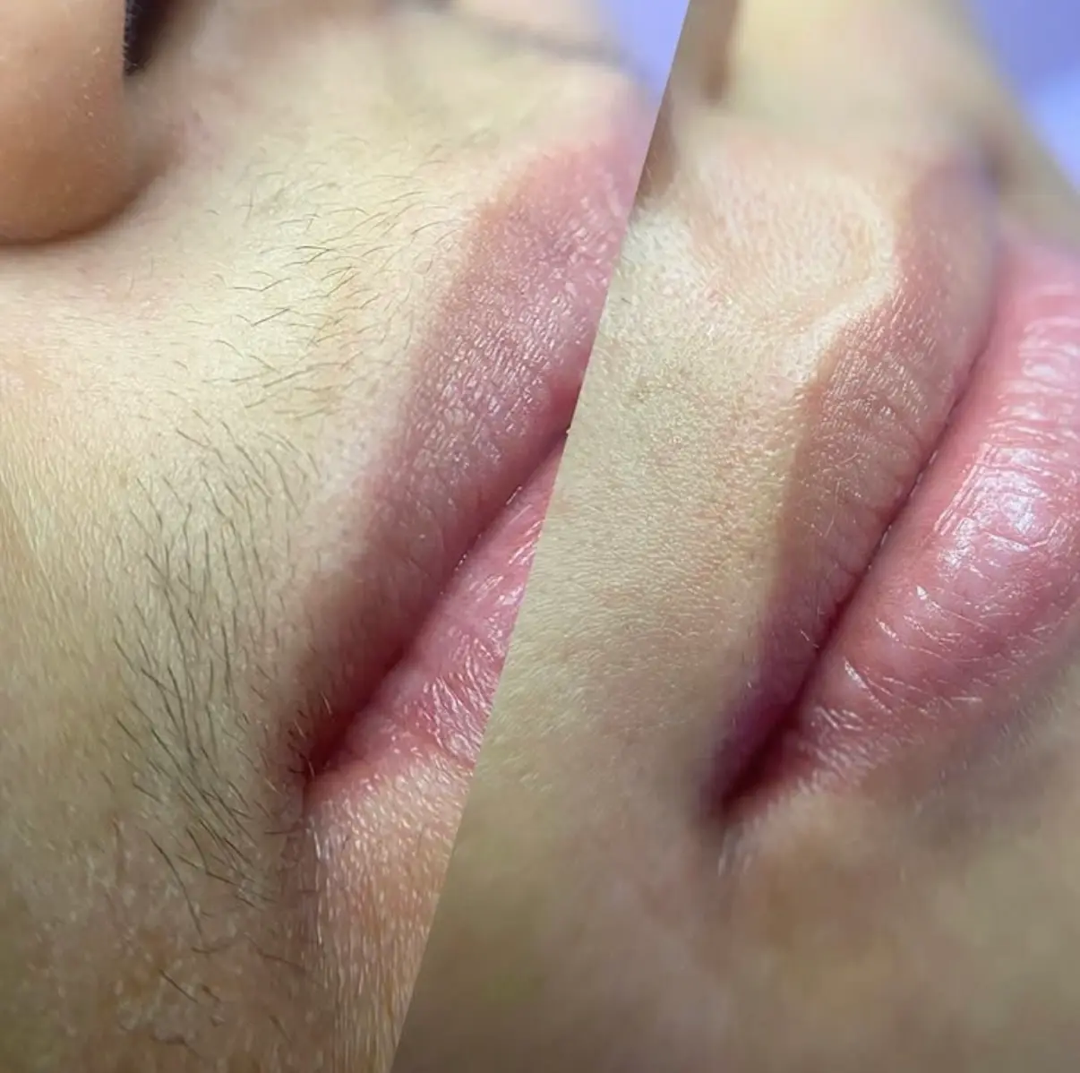 Depilação com cera na região do buço